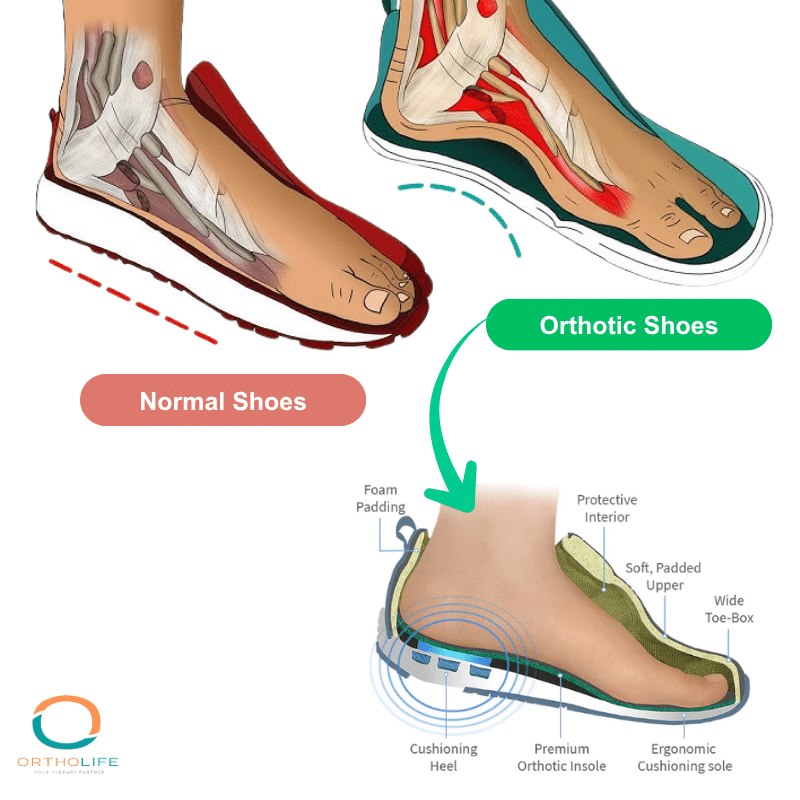 perbedaan sepatu biasa dengan sepatu ortotik